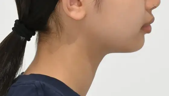 무턱 성장 유도 사례 03(기능 장치) 치료 전 얼굴 옆모습 사진