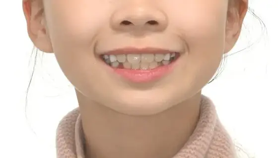 공간 부족 · 악궁 확장 사례 02(악궁 확장) 치료 후 얼굴 정면 사진 – 겹친 치아 완화와 배열 정돈, 치료기간 12개월