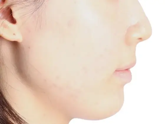 돌출입 교정 사례 04(비수술 교정) 치료 후 얼굴 옆모습 사진 – 턱선까지 또렷해진 측면