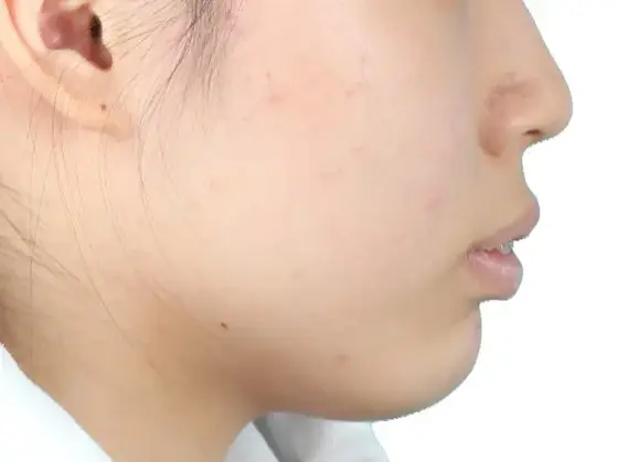 돌출입 교정 사례 04(비수술 교정) 치료 전 얼굴 옆모습 사진