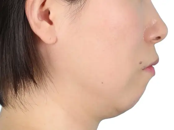 무턱 교정 사례 01(비수술 교정) 치료 전 얼굴 옆모습 사진