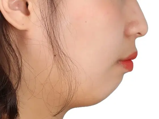 무턱 교정 사례 02(비수술 교정) 치료 전 얼굴 옆모습 사진