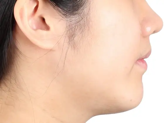 주걱턱 (수술) 사례 01(수술 교정) 치료 후 얼굴 옆모습 사진 – 위·아래턱 차이 개선, 치료기간 32개월